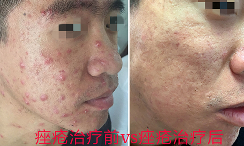 用蜂蜜如何去痘痘?
